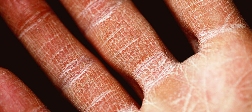 Ease the Pain and Itchiness of Eczema