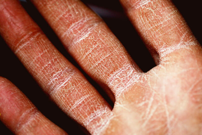 Ease the Pain and Itchiness of Eczema